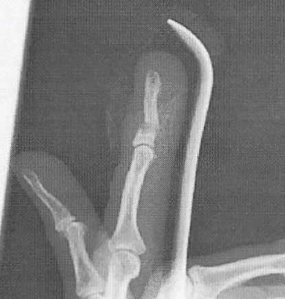 左手薬指骨折